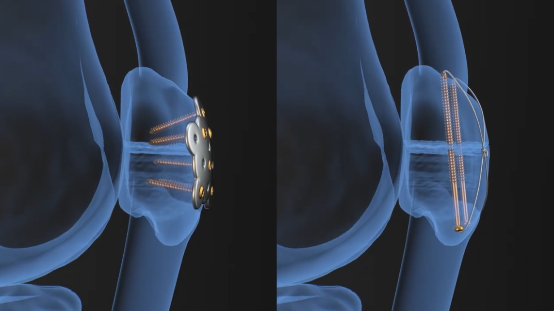 Clinical Advantages video
