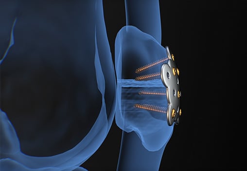 3D cutaway render of The Summit™ Patella Plate fixed to the patella with locking screws