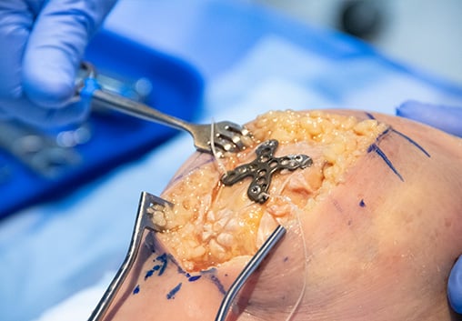 The Summit™ Patella Plate secured to the patella in an open surgical field