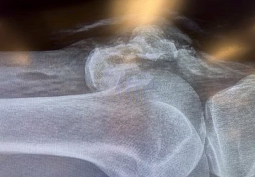 Lateral X-ray of a knee joint