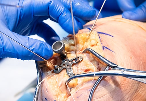 The Summit™ Patella Plate positioned on the patella with olive screws during surgery