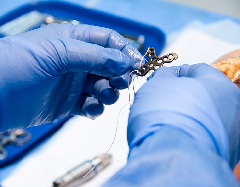 Gloved surgeon positioning The Summit™ Patella Plate during a procedure