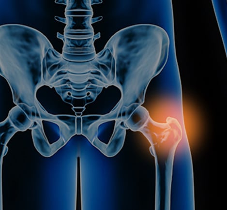 X-ray-style illustration of a pelvis with the greater trochanter highlighted in orange
