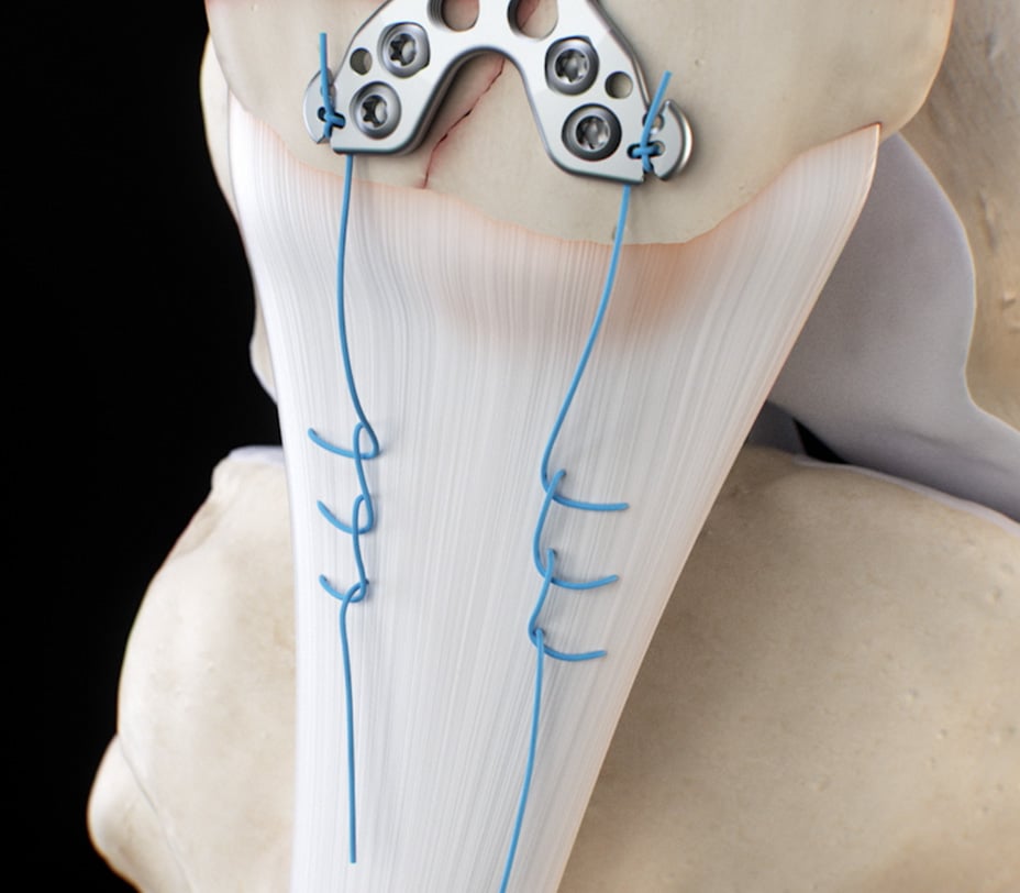 Krackow sutures woven down each side of the patellar tendon toward the tibial tuberosity