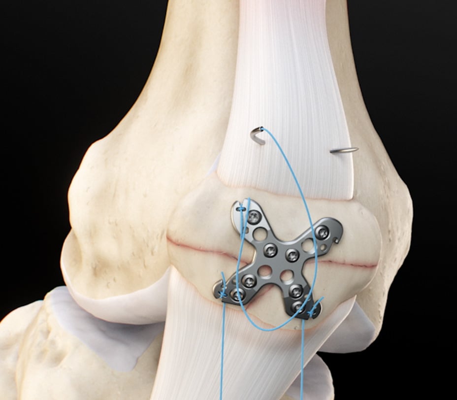 Side view of the plated patella with suture passed through the quadriceps tendon
