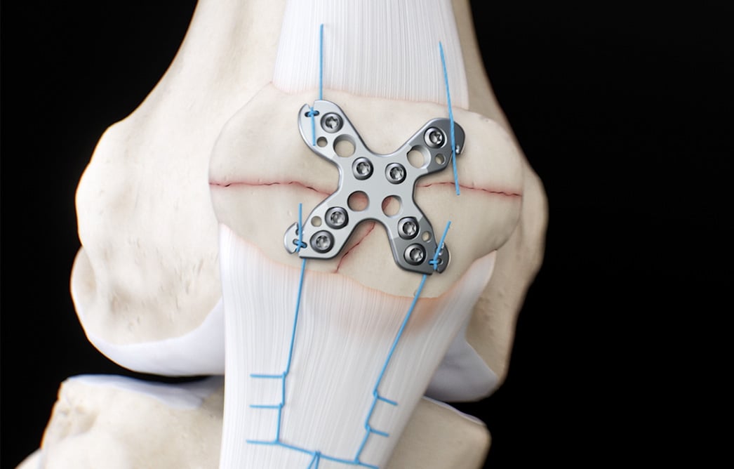 The Summit™ Patella Plate secured to a patella with sutures running to the tendons