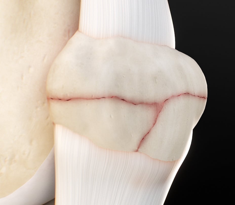 Anatomical model of a patella showing a transverse fracture line before repair