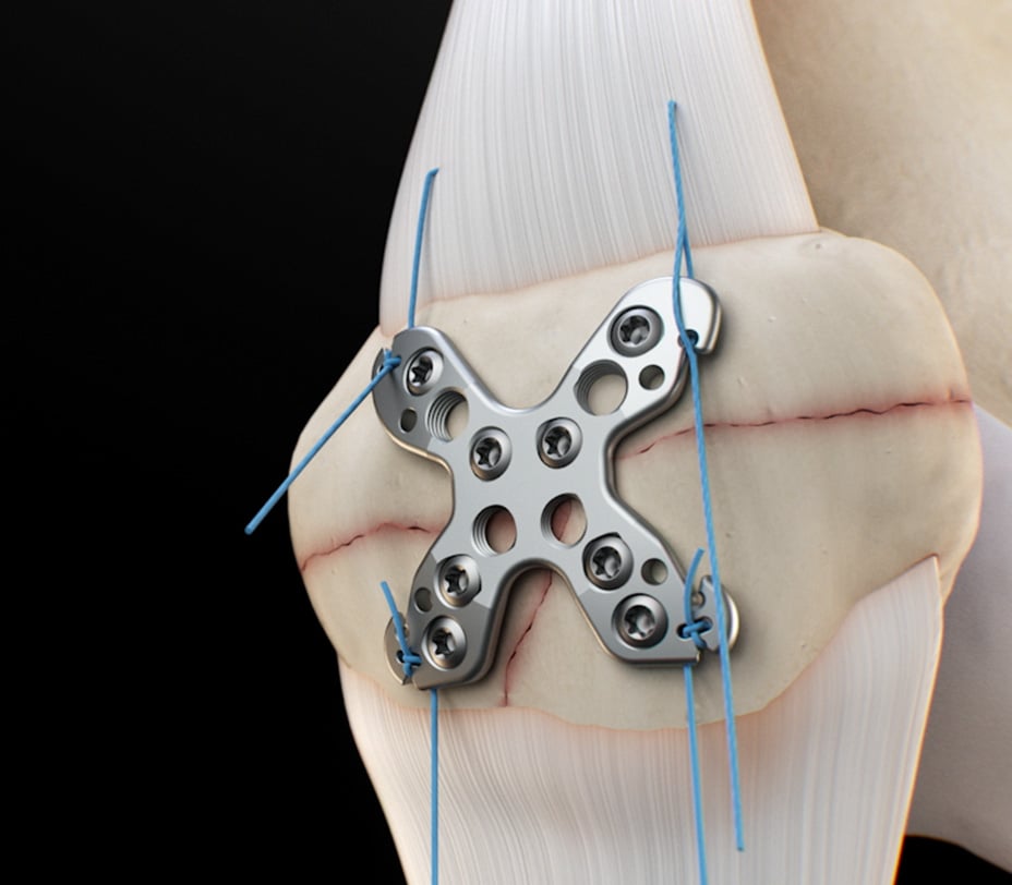 Suture tail pulled superiorly away from the plate to tension the Zip-Knot