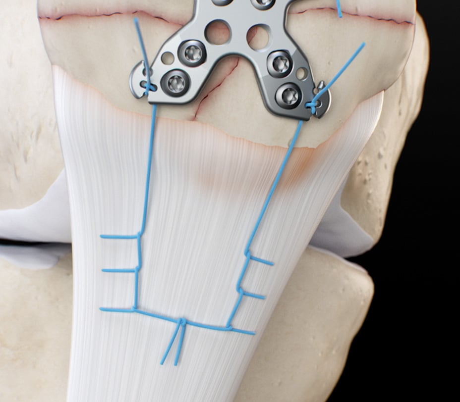 Completed construct with both inferior sutures tensioned through the plate