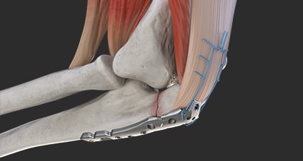 3D anatomical render of an elbow with a plate fixed along the bone and surrounding muscle visible