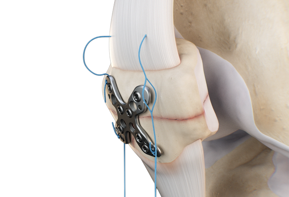 Close-up of the Zip-Knot mechanism on a plated patella, side view