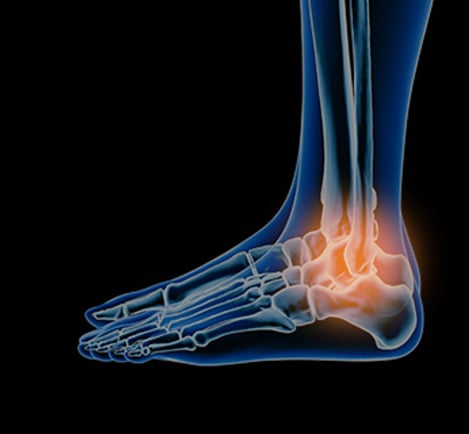X-ray-style illustration of a foot and ankle with the joint highlighted in orange