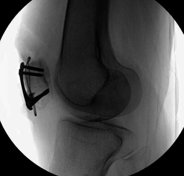 JB&JS Summary: 'Reoperation Following Fracture Repair with Plates'