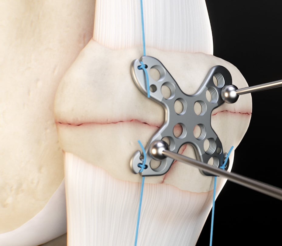 The Summit™ Patella Plate seated on the patella with a drill sleeve positioned over a screw hole