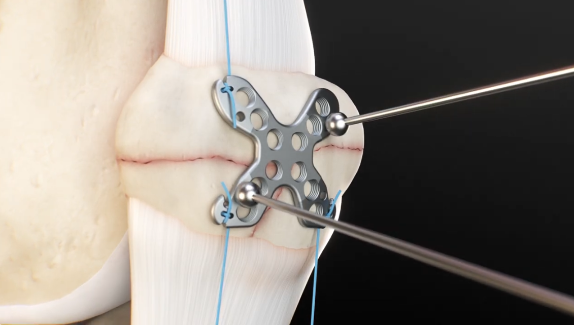 Surgical Technique Video